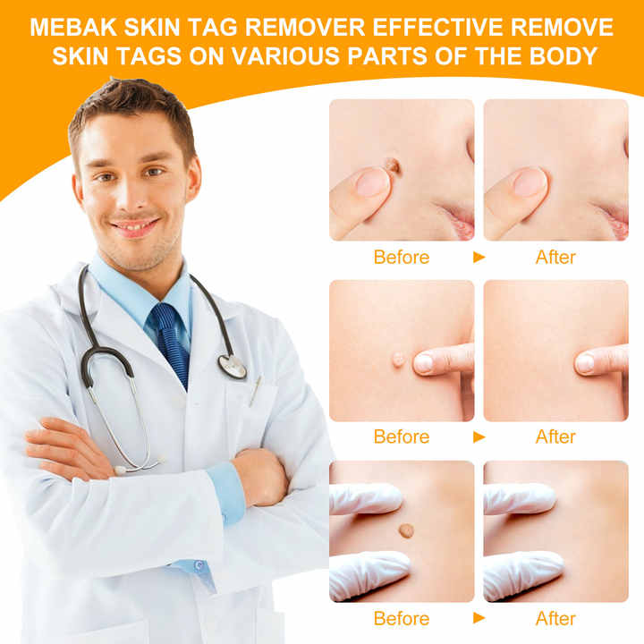 2 In1 Painless Auto Skin Tag Mole Removal Kit - Image 2