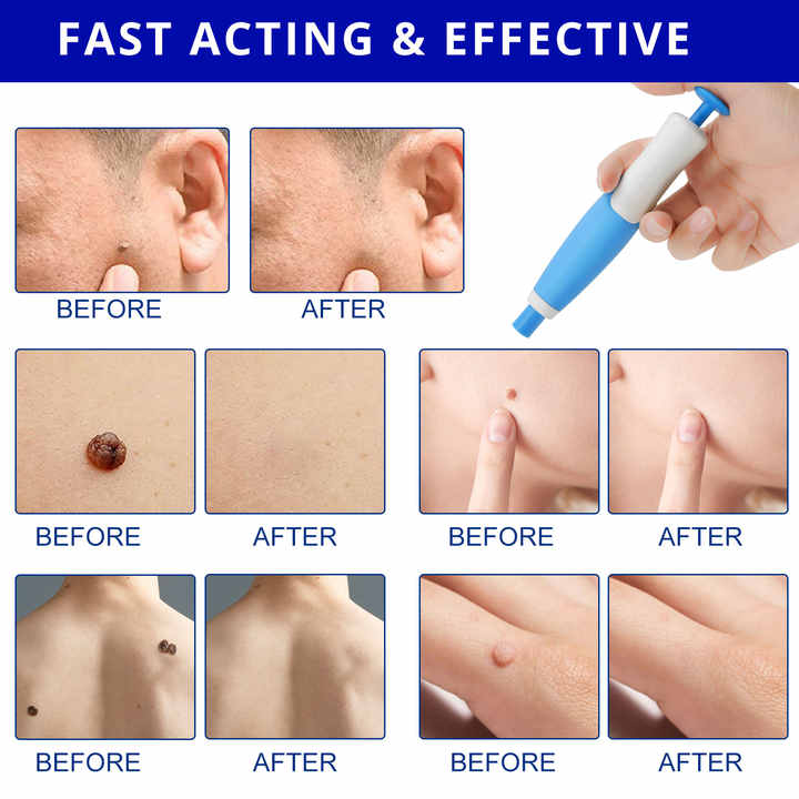 2 In1 Painless Auto Skin Tag Mole Removal Kit - Image 5