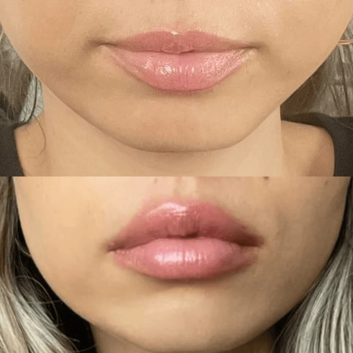 LIP VOLUMIZER - Image 4