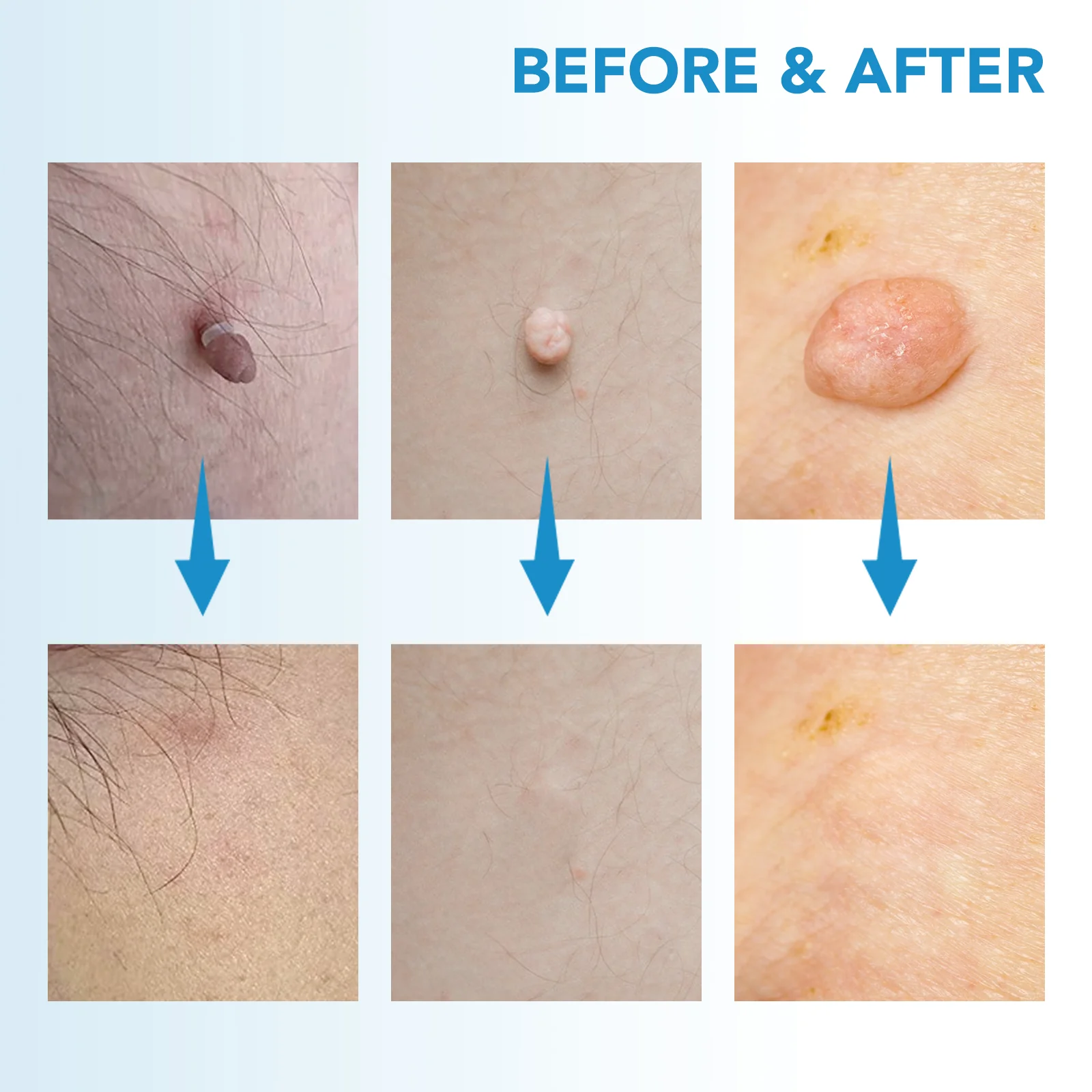 MicroCare Skin Solution - Advanced Skin Tag, Wart, Acne, and Pimple Removal Kit - Image 6
