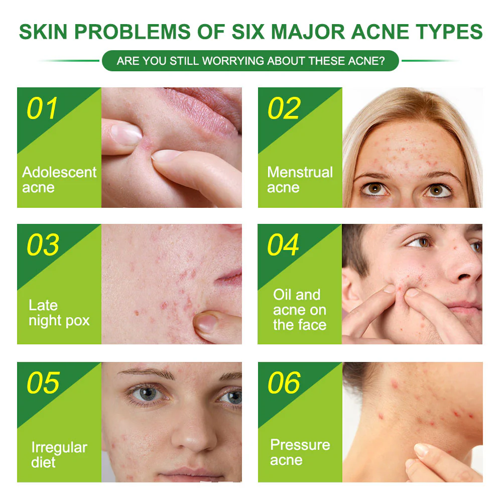 Pimple Patch: Hydrocolloid Acne Treatment - Image 3