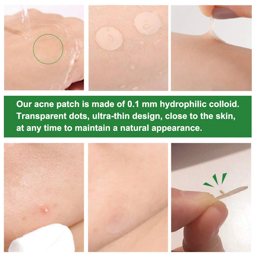 Pimple Patch: Hydrocolloid Acne Treatment - Image 4