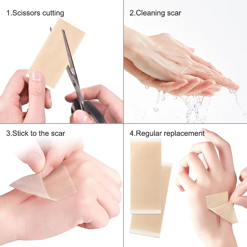 Silicone Gel Sheets for Scar - Image 3