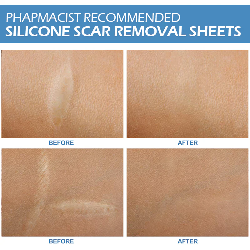 Silicone Gel Sheets for Scar - Image 4
