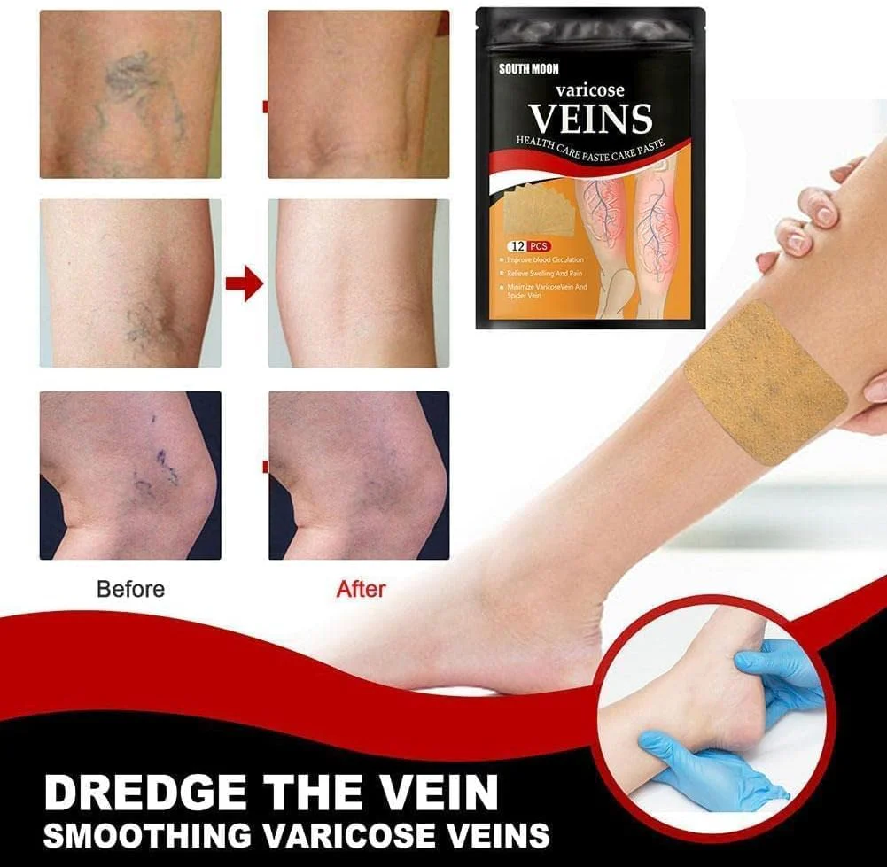 Varicose Veins Patch - Image 2
